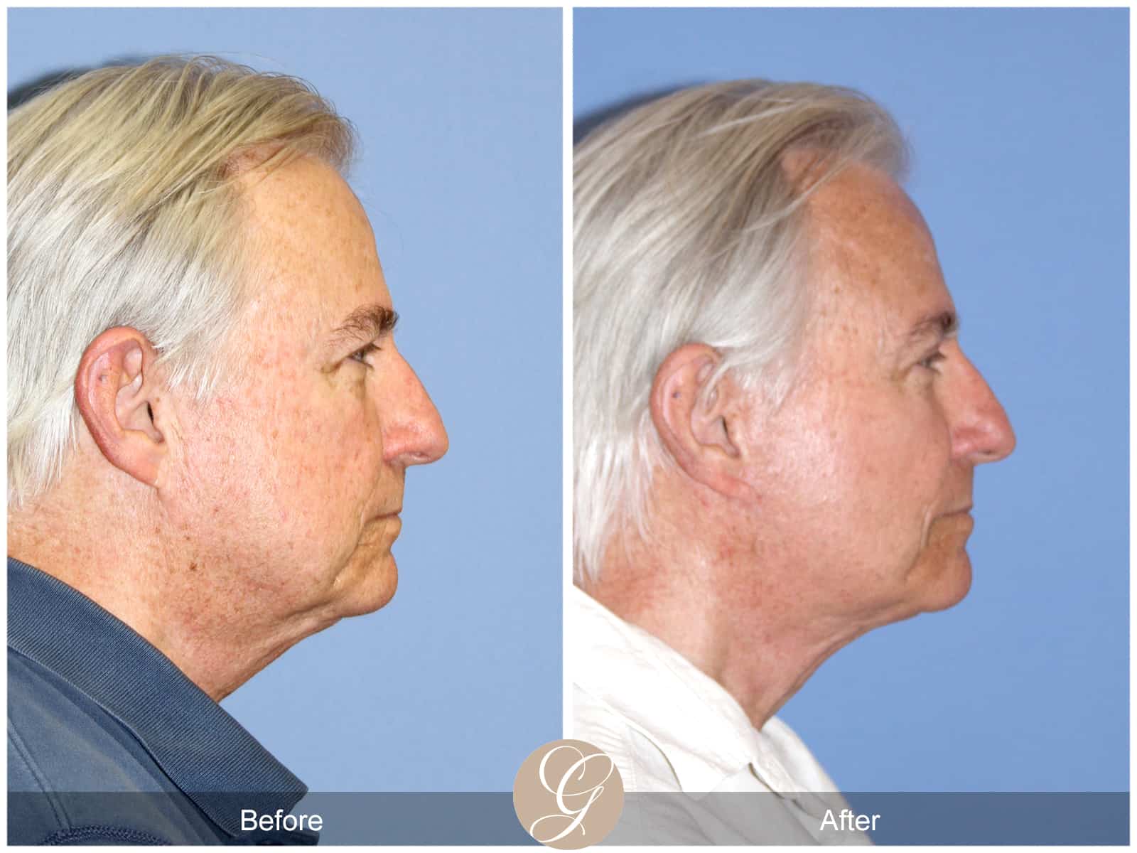 Neck Lift- 409 Image