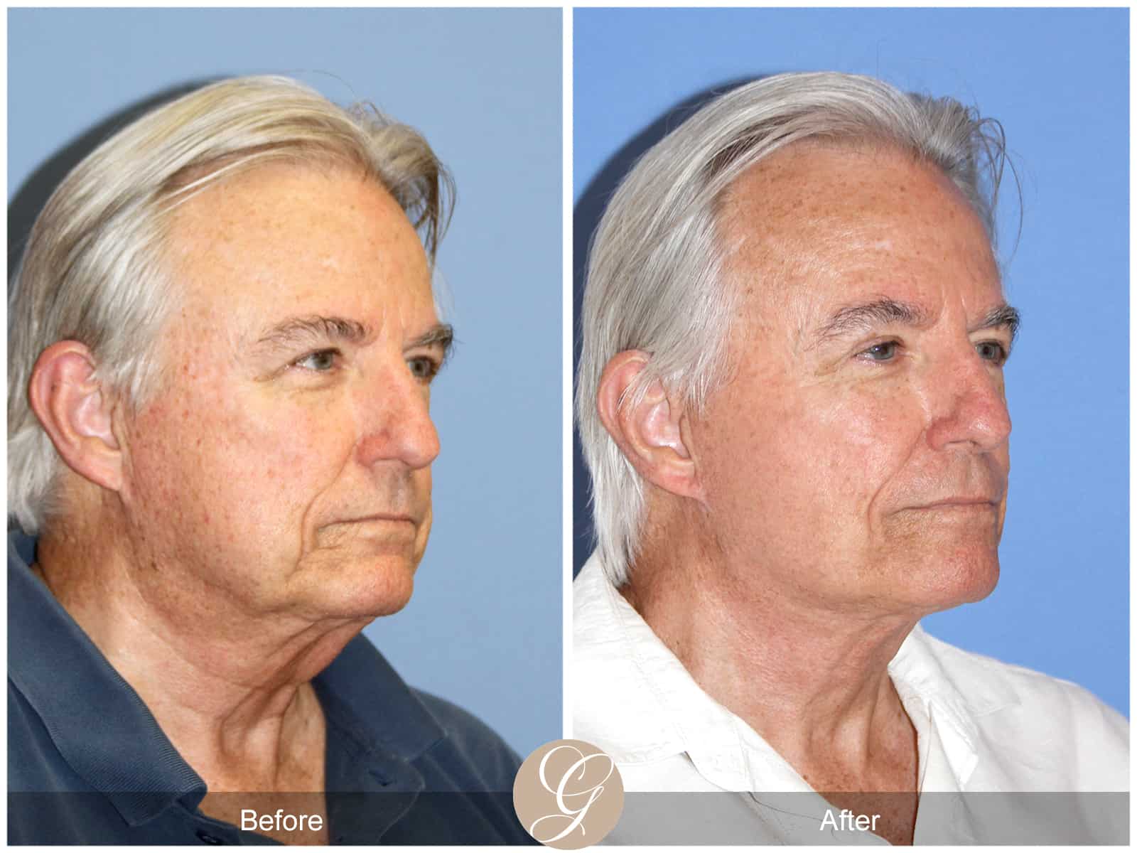 Neck Lift- 409 Image