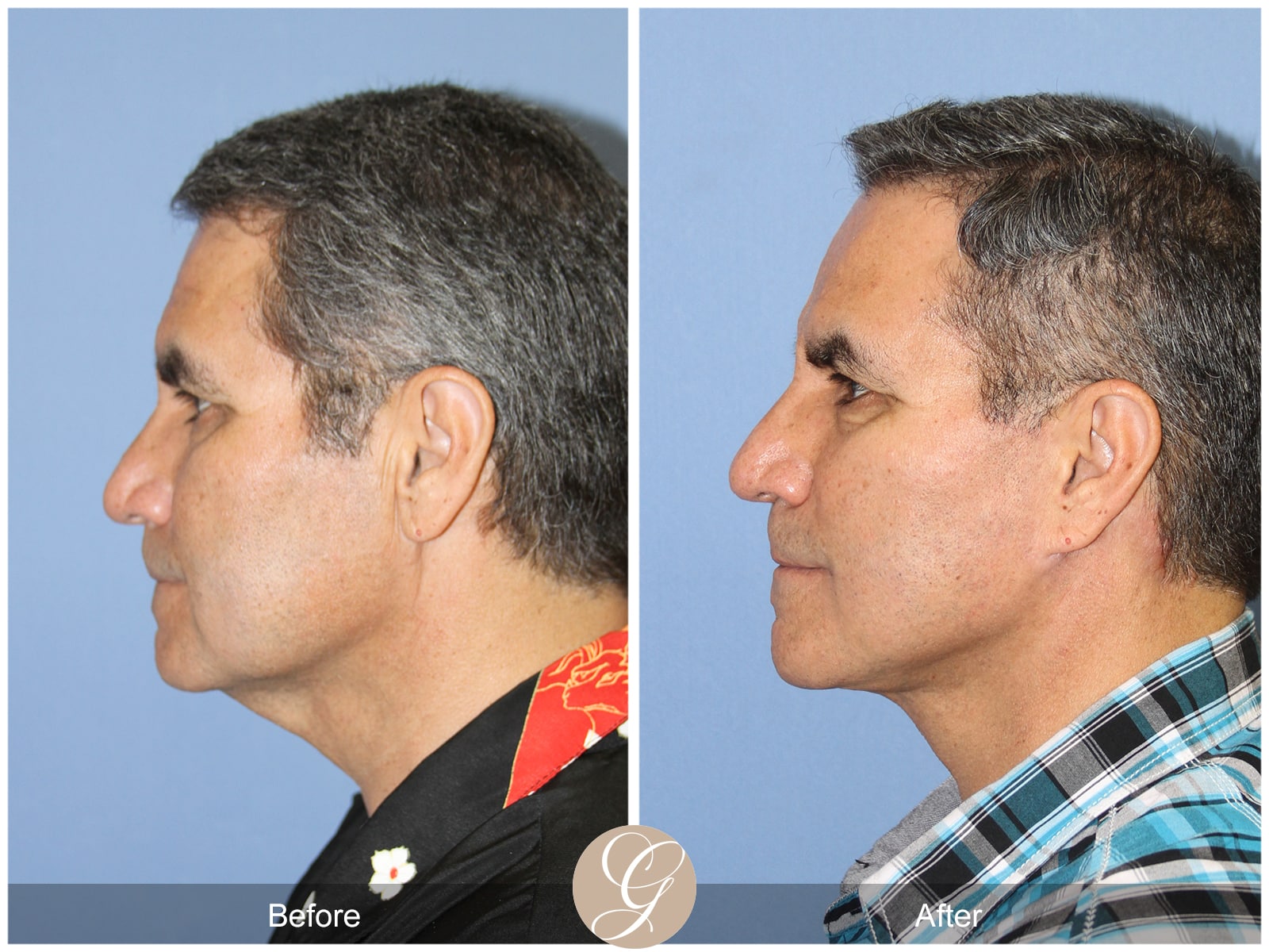 Facelift Santa Clarita CA Image