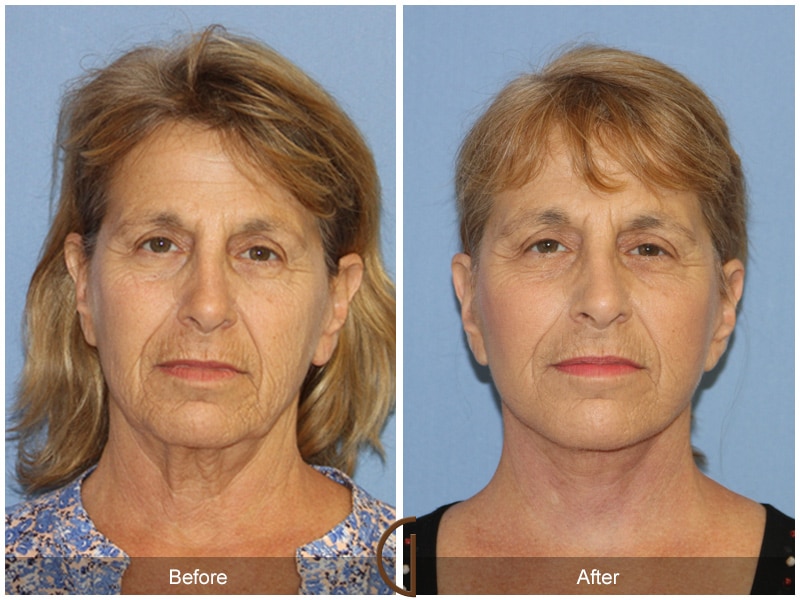 Natural Facelift 411 Image
