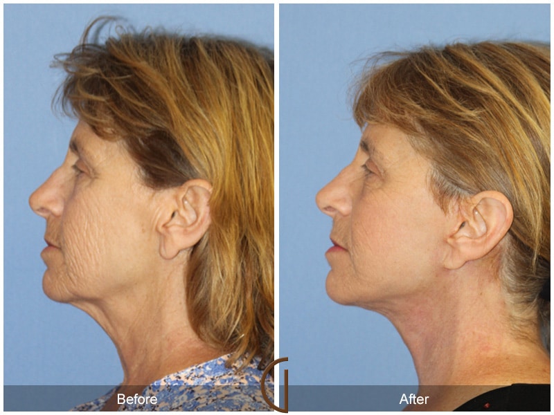 Natural Facelift 411 Image