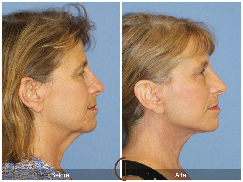 Natural Facelift 411 Image