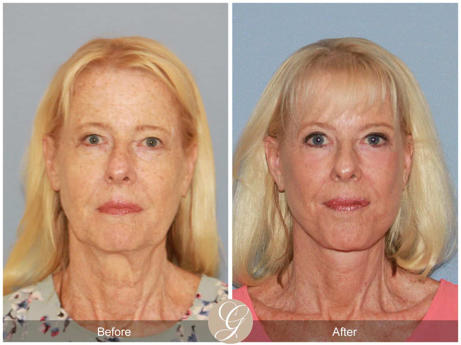 Neck Lift- 412 Image