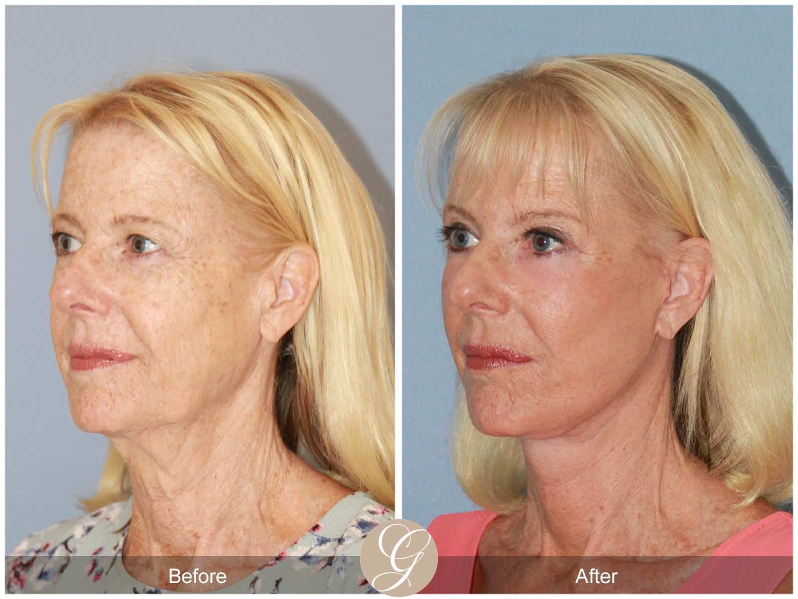 Neck Lift- 412 Image