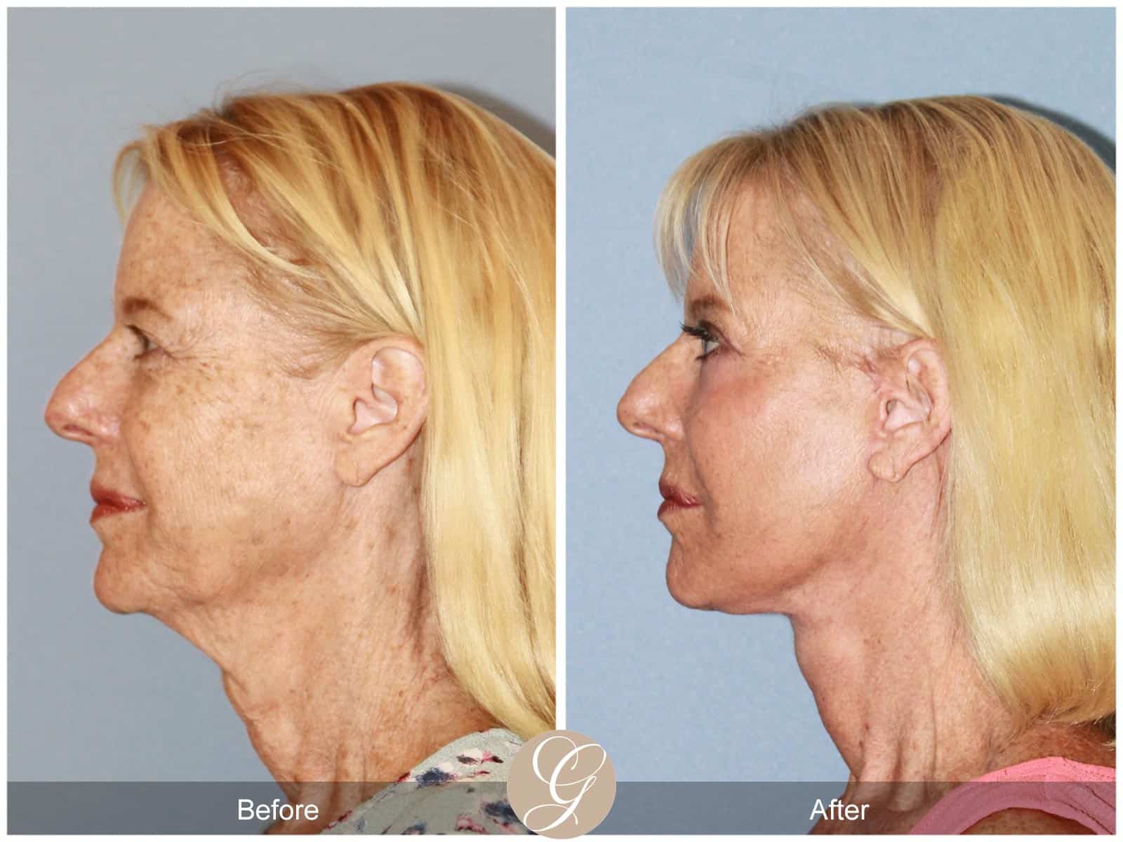 Neck Lift- 412 Image