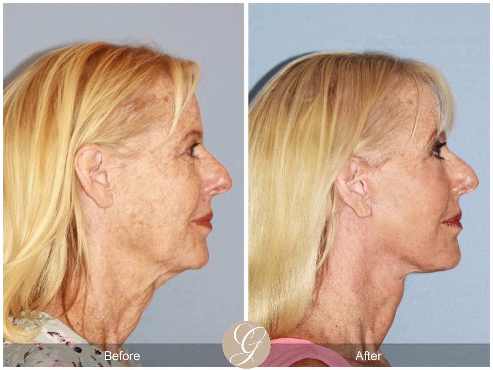 Neck Lift- 412 Image