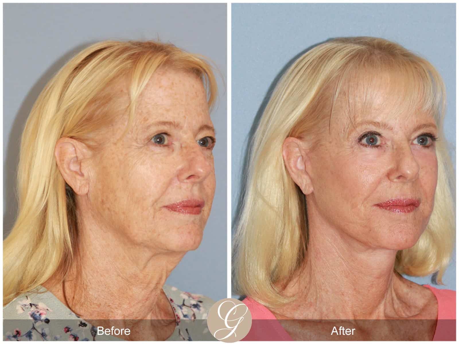 Neck Lift- 412 Image