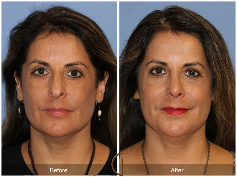 Rhinoplasty 109 Image