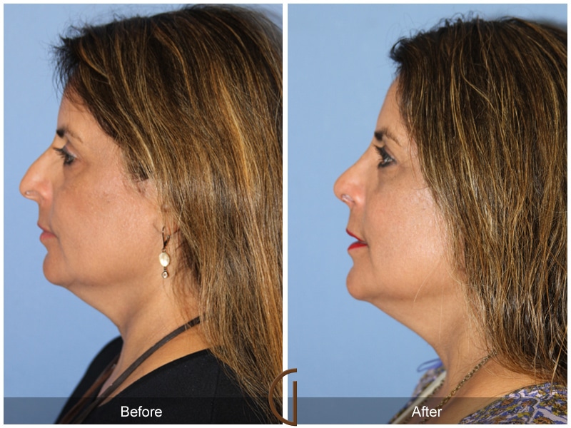 Rhinoplasty 109 Image
