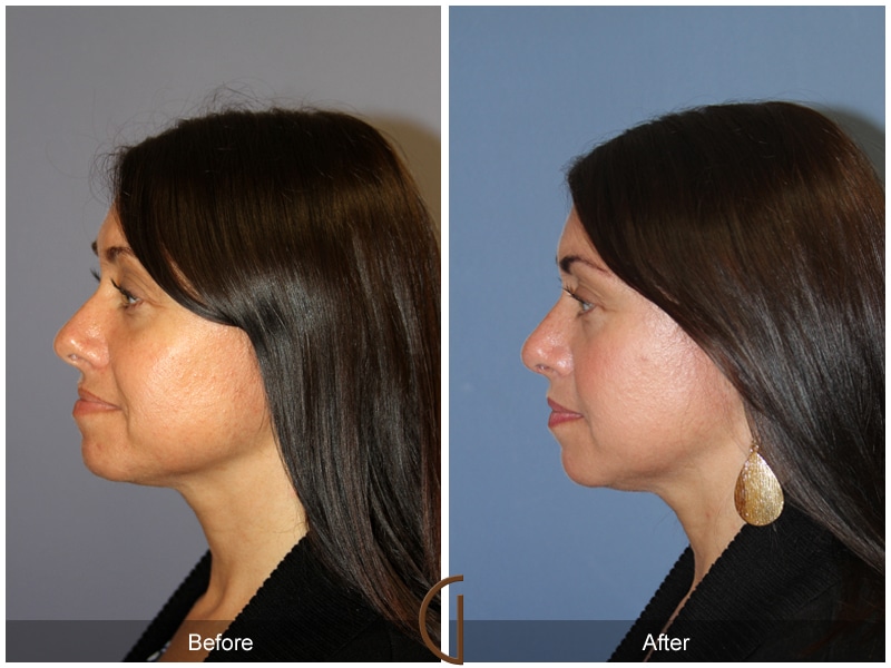 Tip Rhinoplasty 110 Image