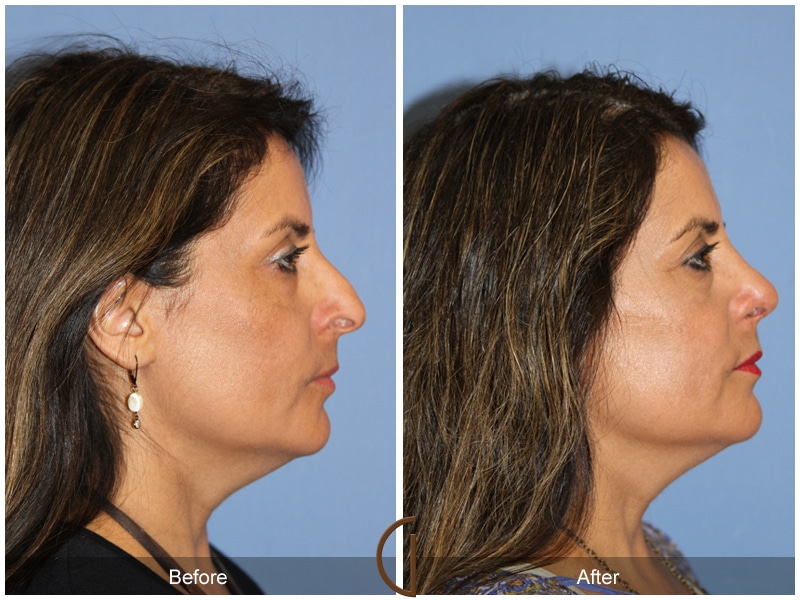 Rhinoplasty 109 Image