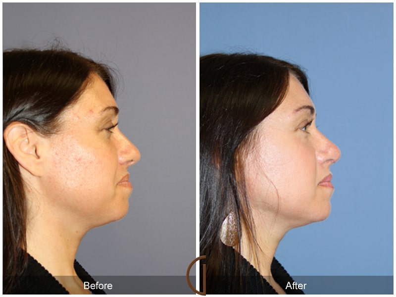 Tip Rhinoplasty 110 Image