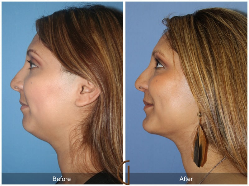 Chin Augmentation Orange County CA 117 Image