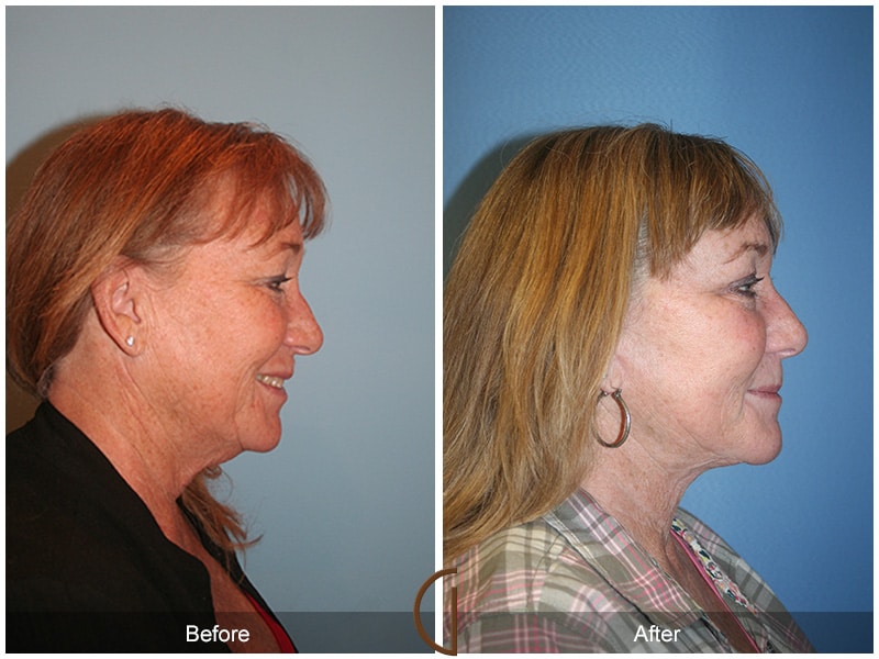 Orange County Newport Beach Facelift 5 Image