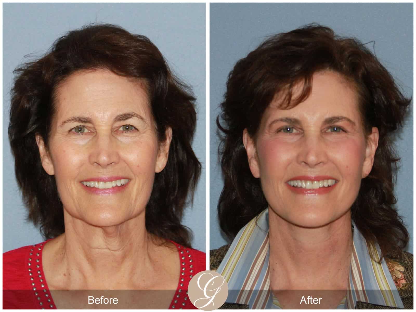 Natural Facelift- 408 Image