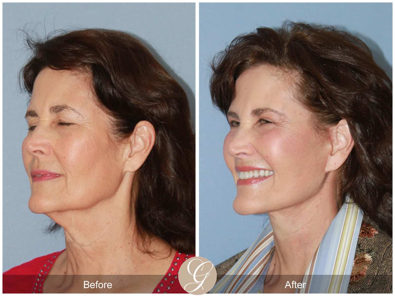 Natural Facelift- 408 Image