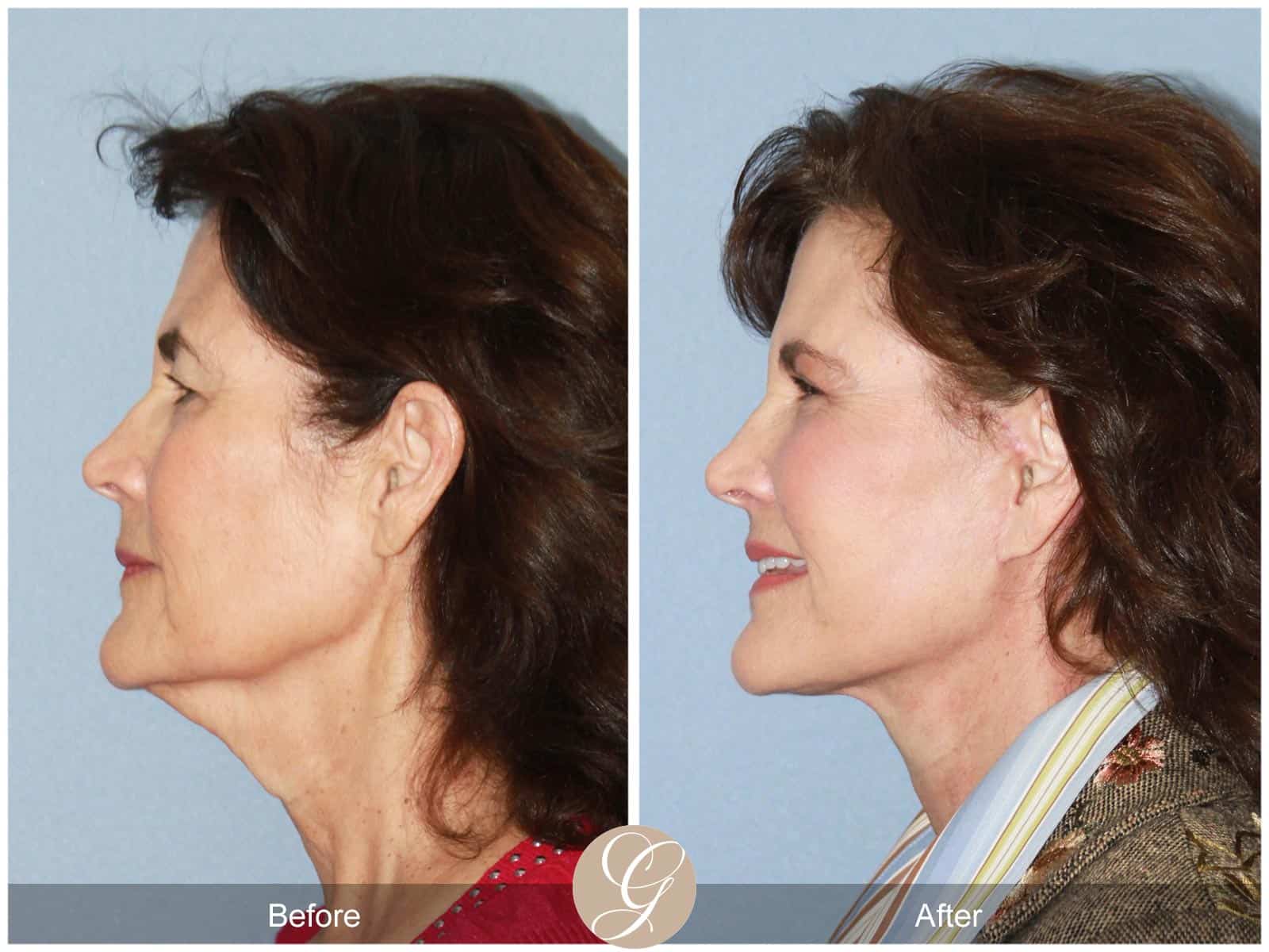 Natural Facelift- 408 Image