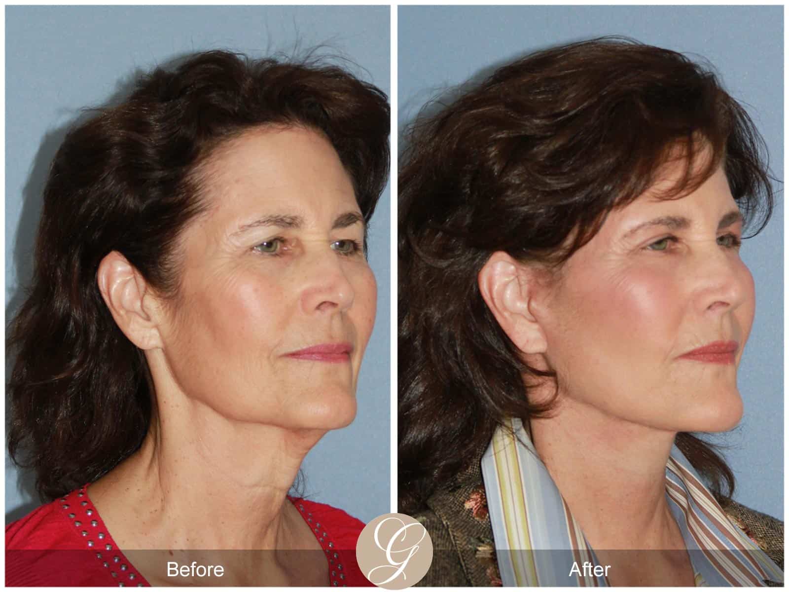 Natural Facelift- 408 Image