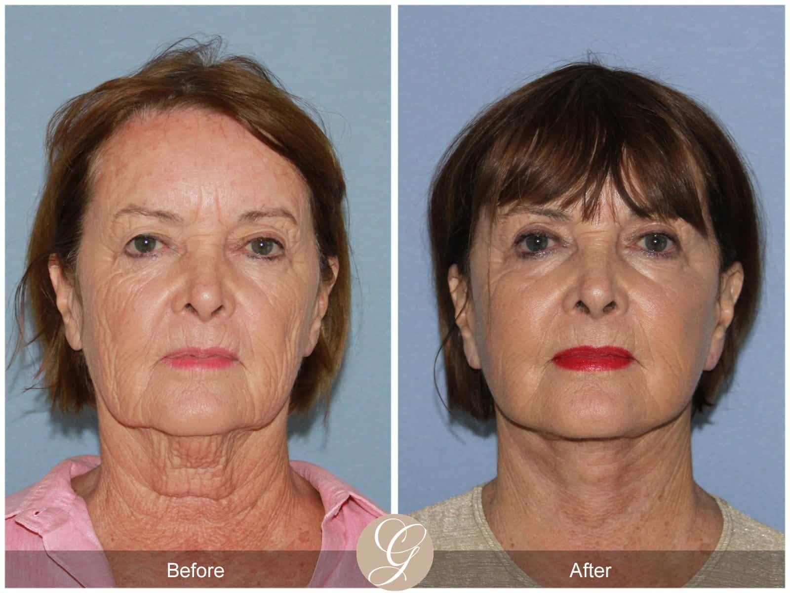 Neck Lift- 405 Image