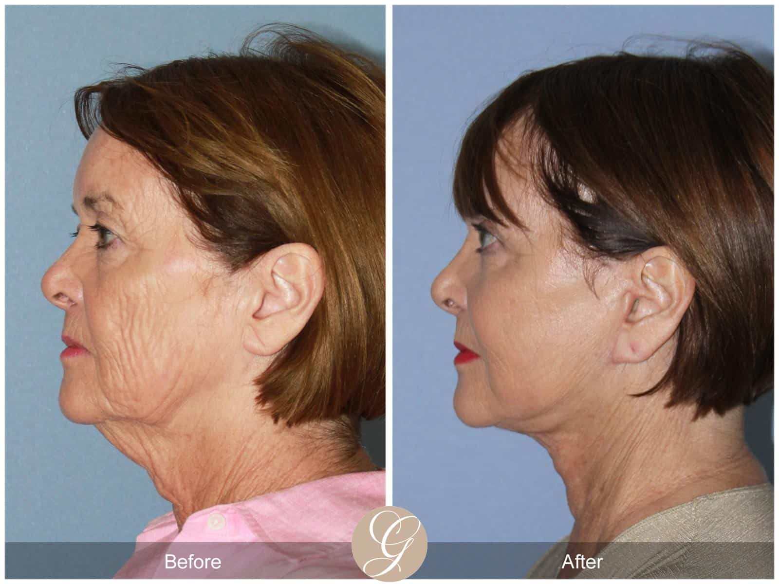 Neck Lift- 405 Image
