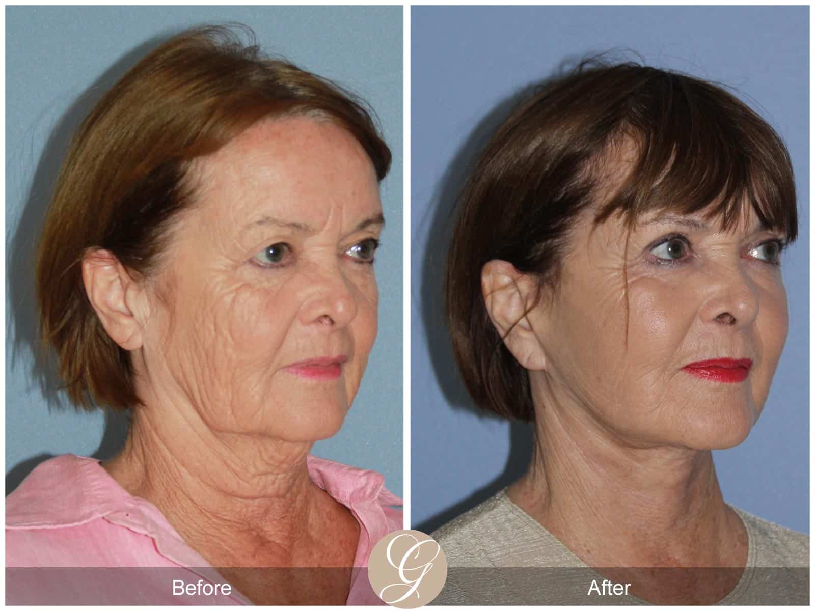 Neck Lift- 405 Image
