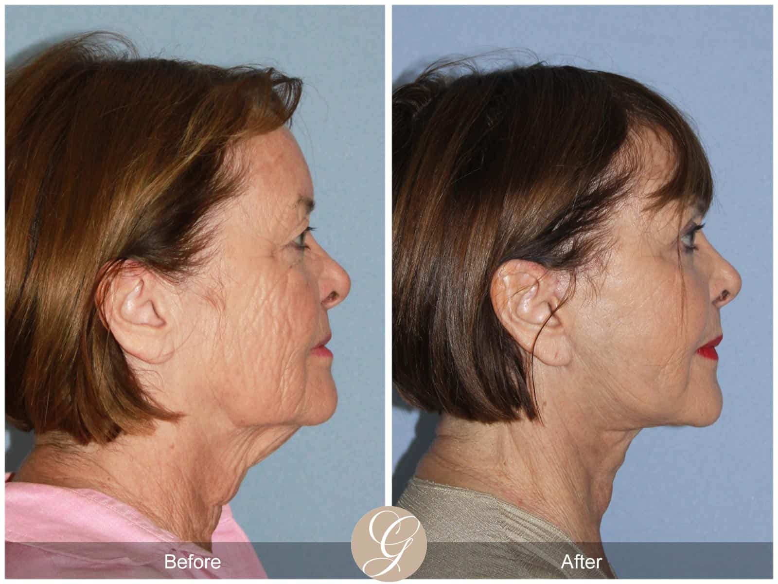 Neck Lift- 405 Image