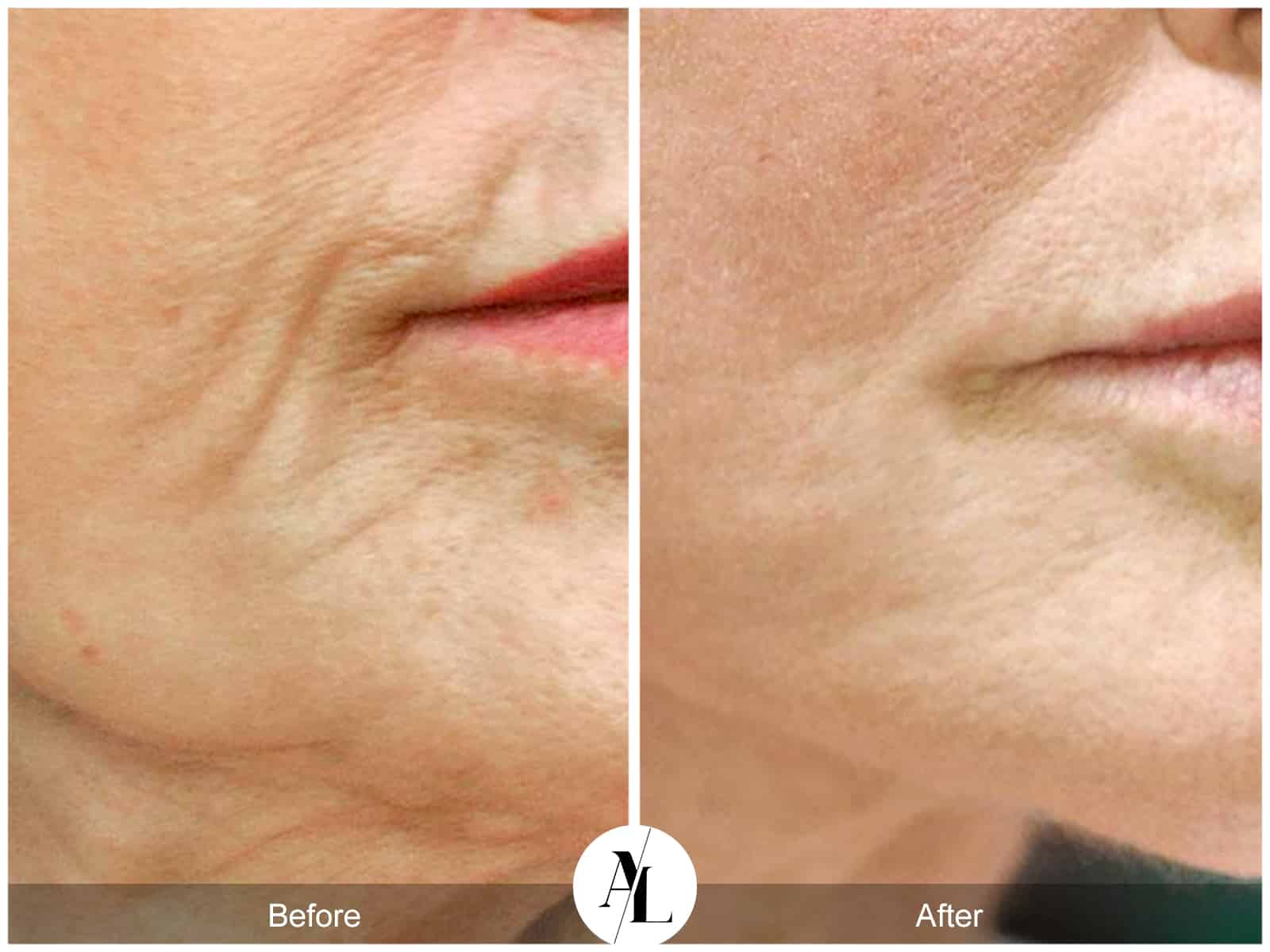 PROFOUND SKIN TIGHTENING- 7 Image