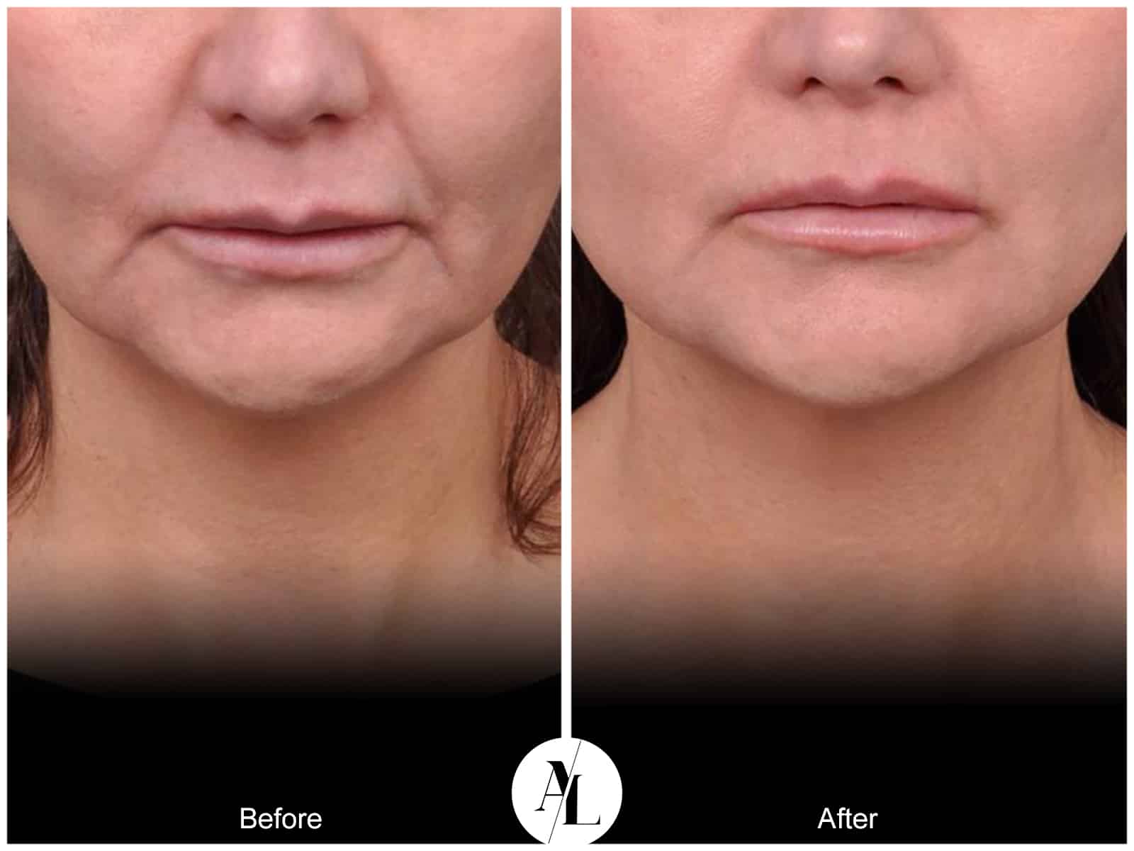 PROFOUND SKIN TIGHTENING- 5 Image