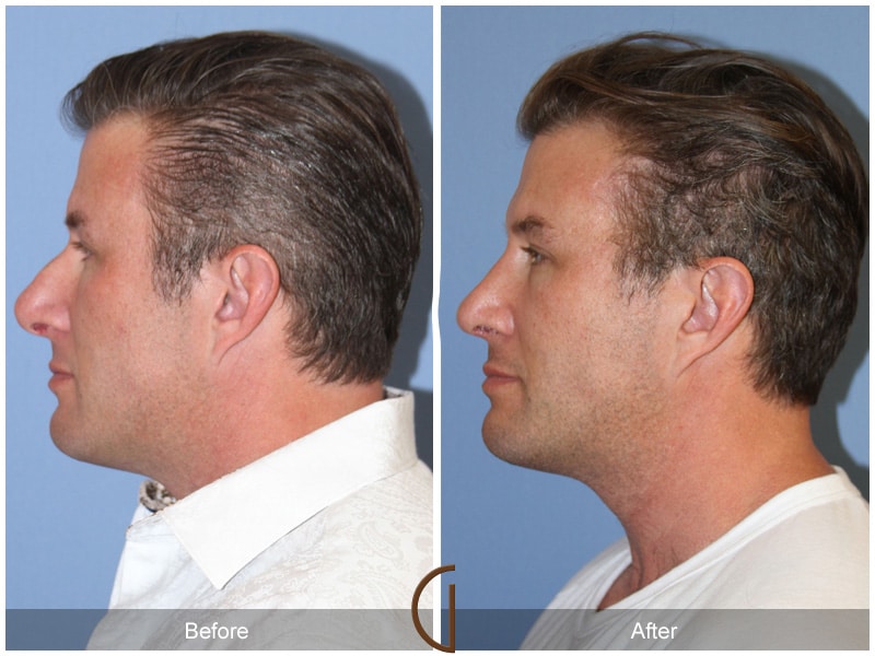 Septorhinoplasty 107 Image