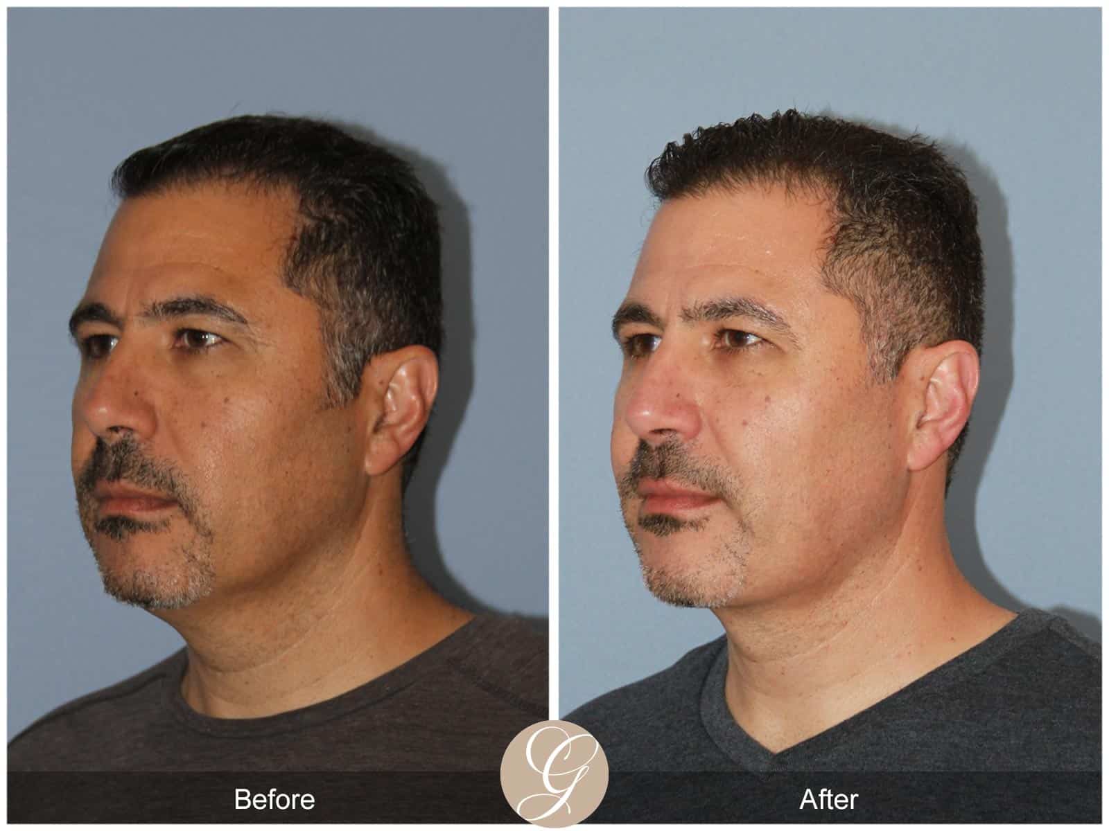 Profound skin tightening-1 Image