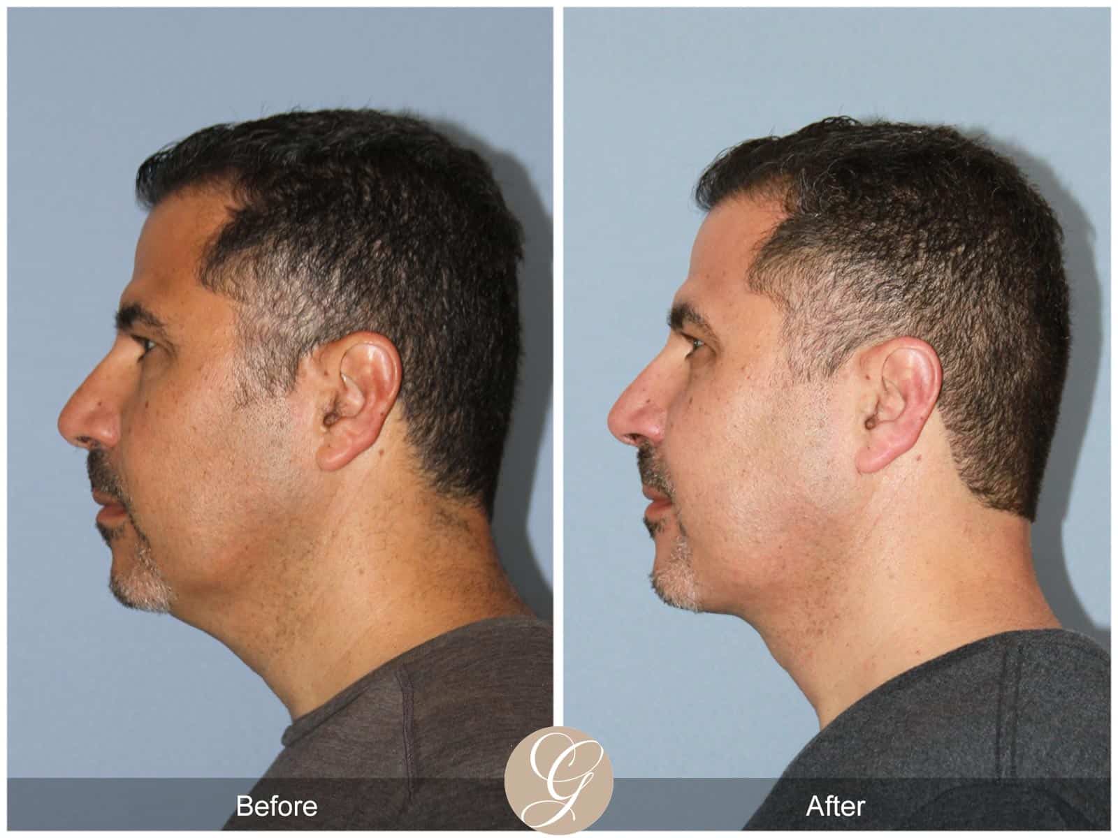 Profound skin tightening-1 Image