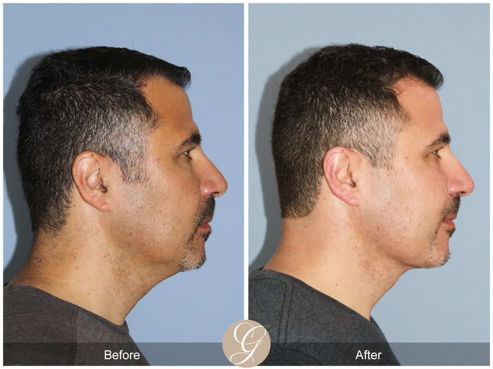 Profound skin tightening-1 Image