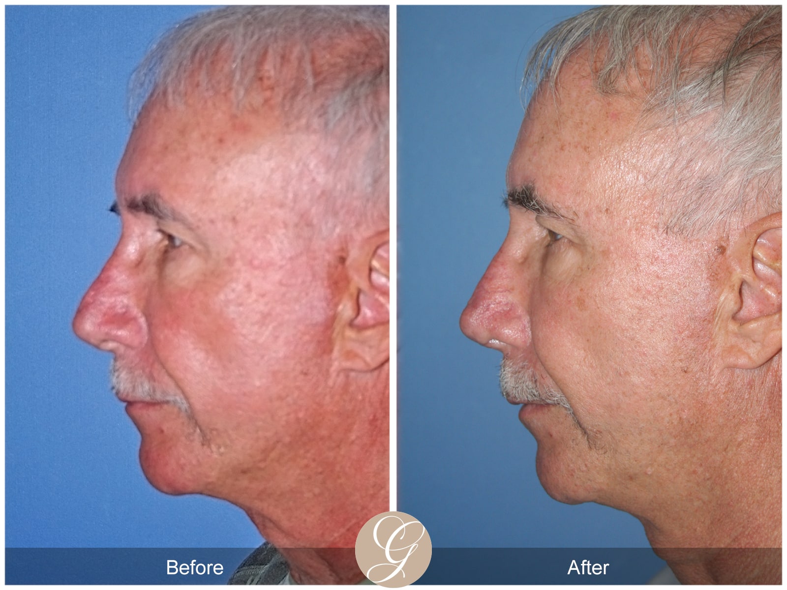 Rhinoplasty 106 Image