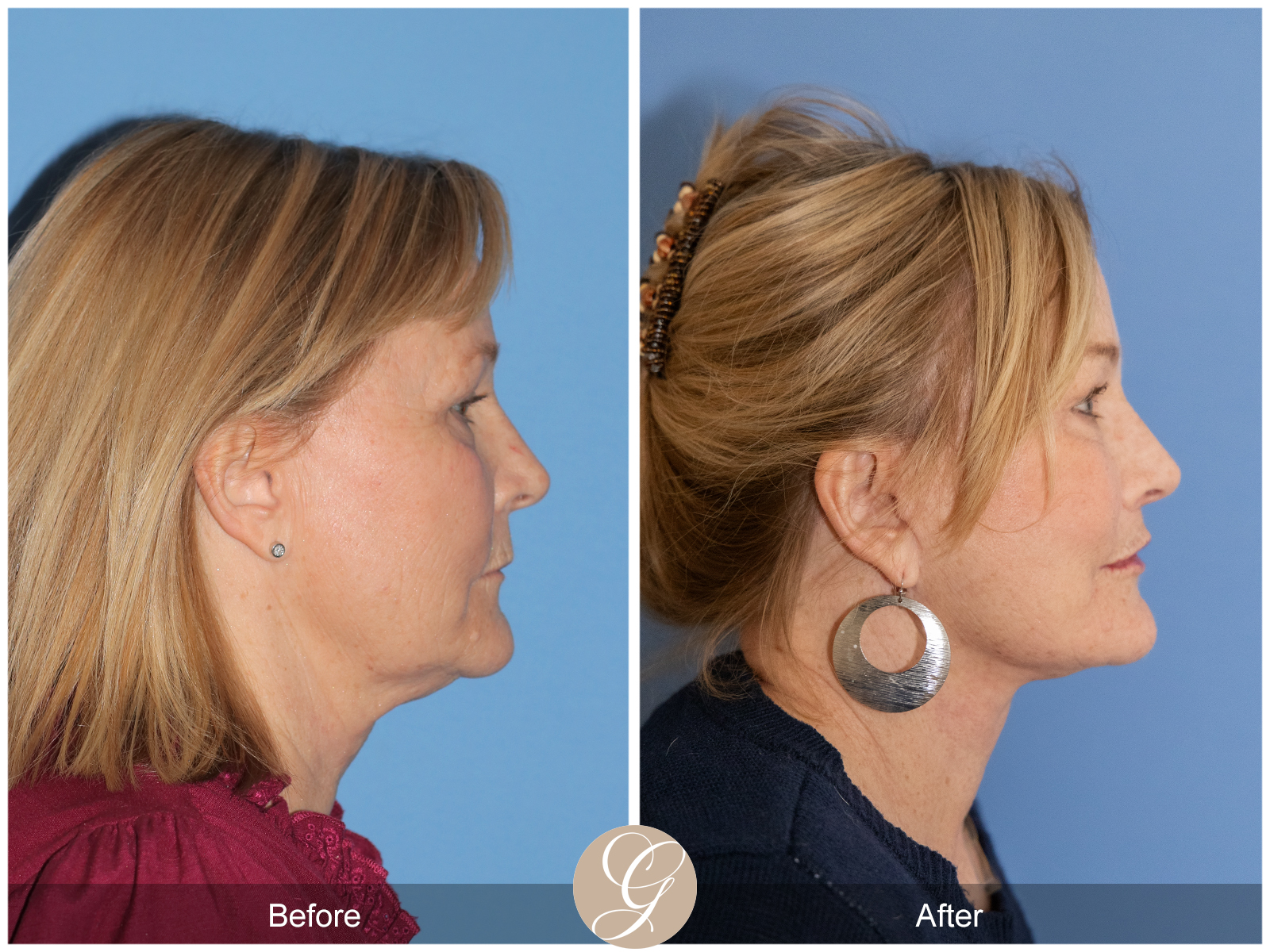 Preservation Facelift Case 10 Image