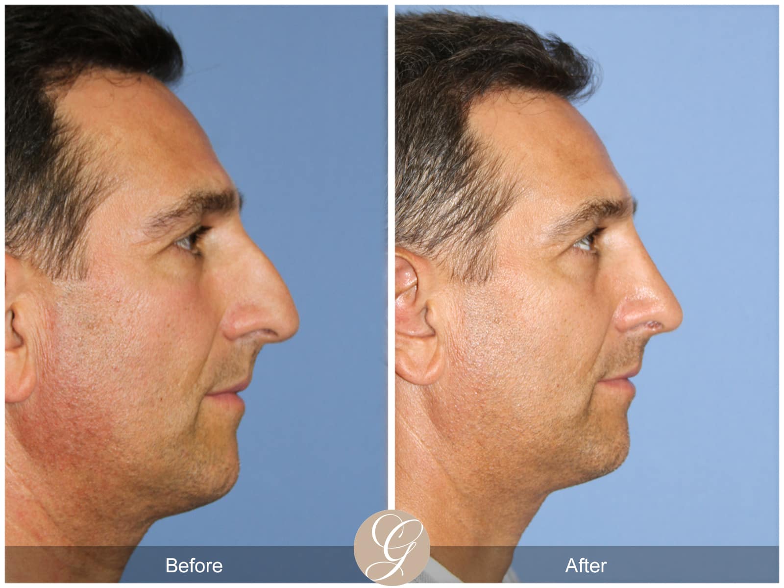 Rhinoplasty 111 Image