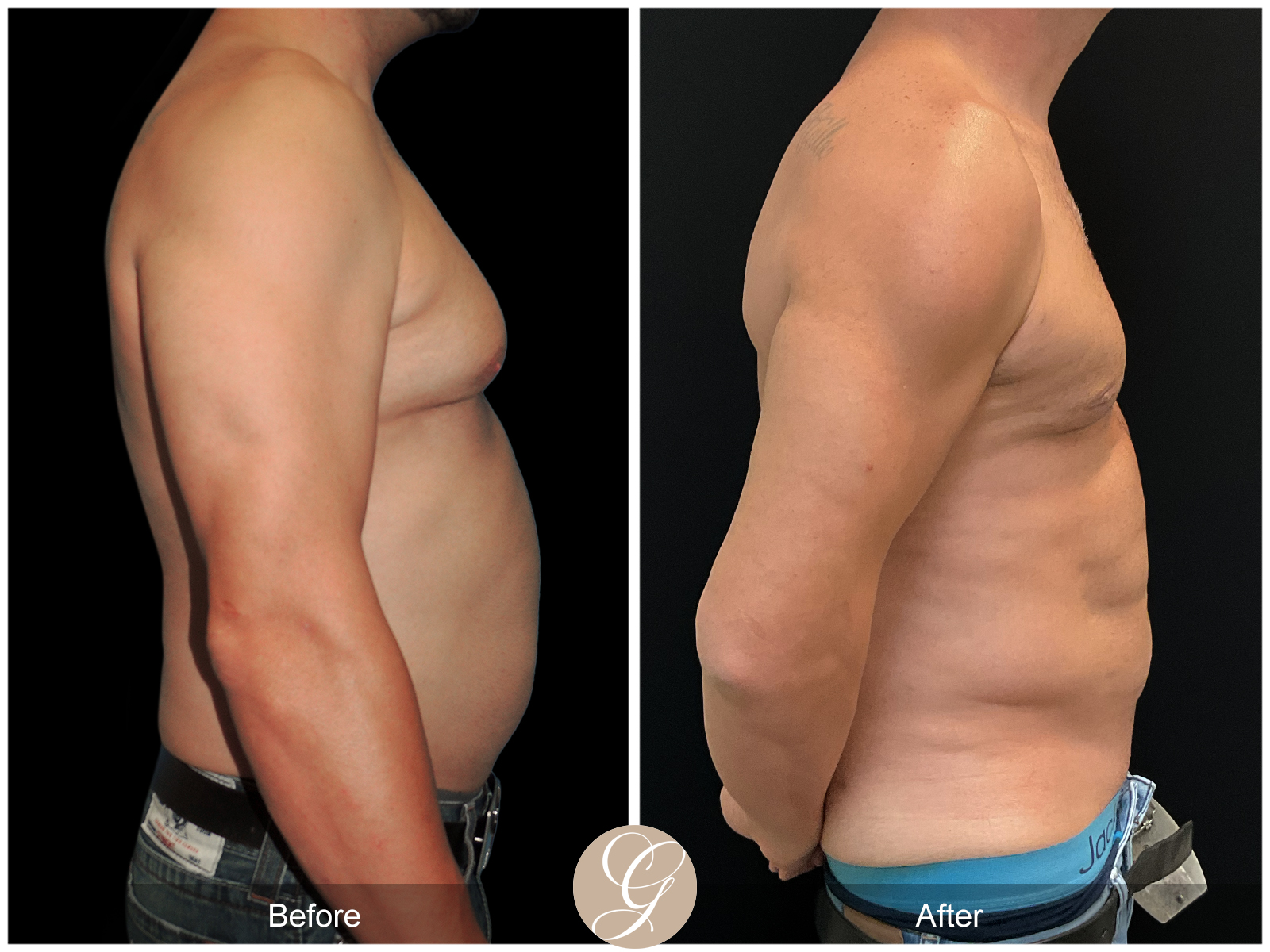 Gynecomastia PT2 Image