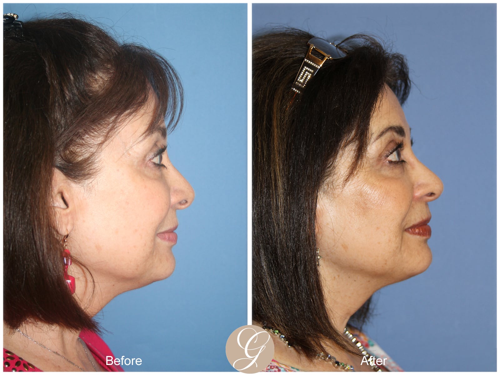 Rhinoplasty 112 Image