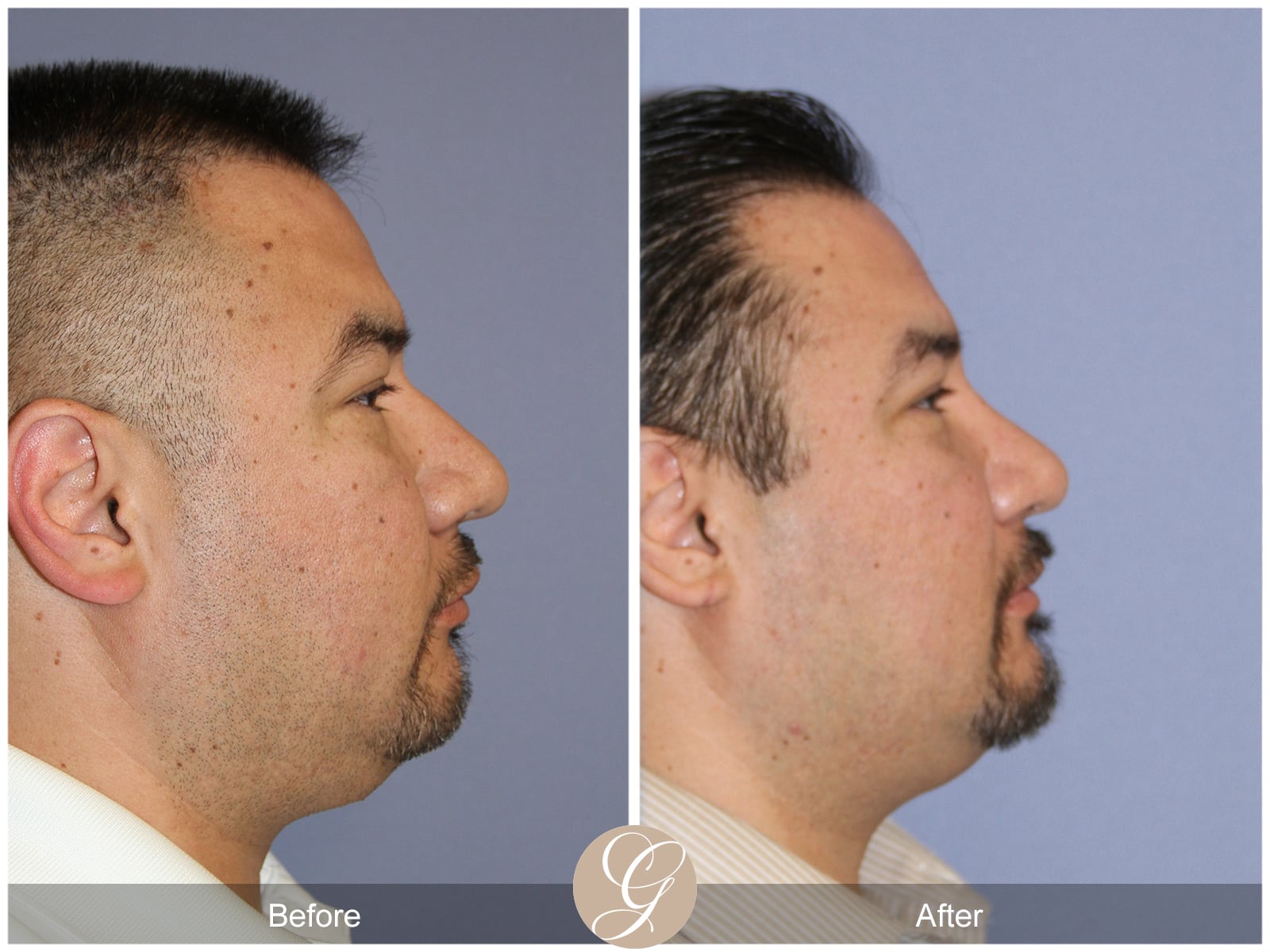 Rhinoplasty 105 Image