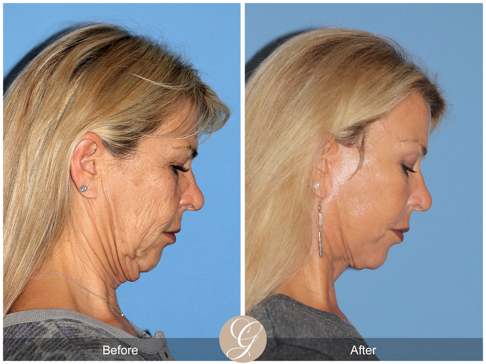The Future of Facial Rejuvenation: The Preservation Deep Plane Faceligy by Dr. Kevin Sadati