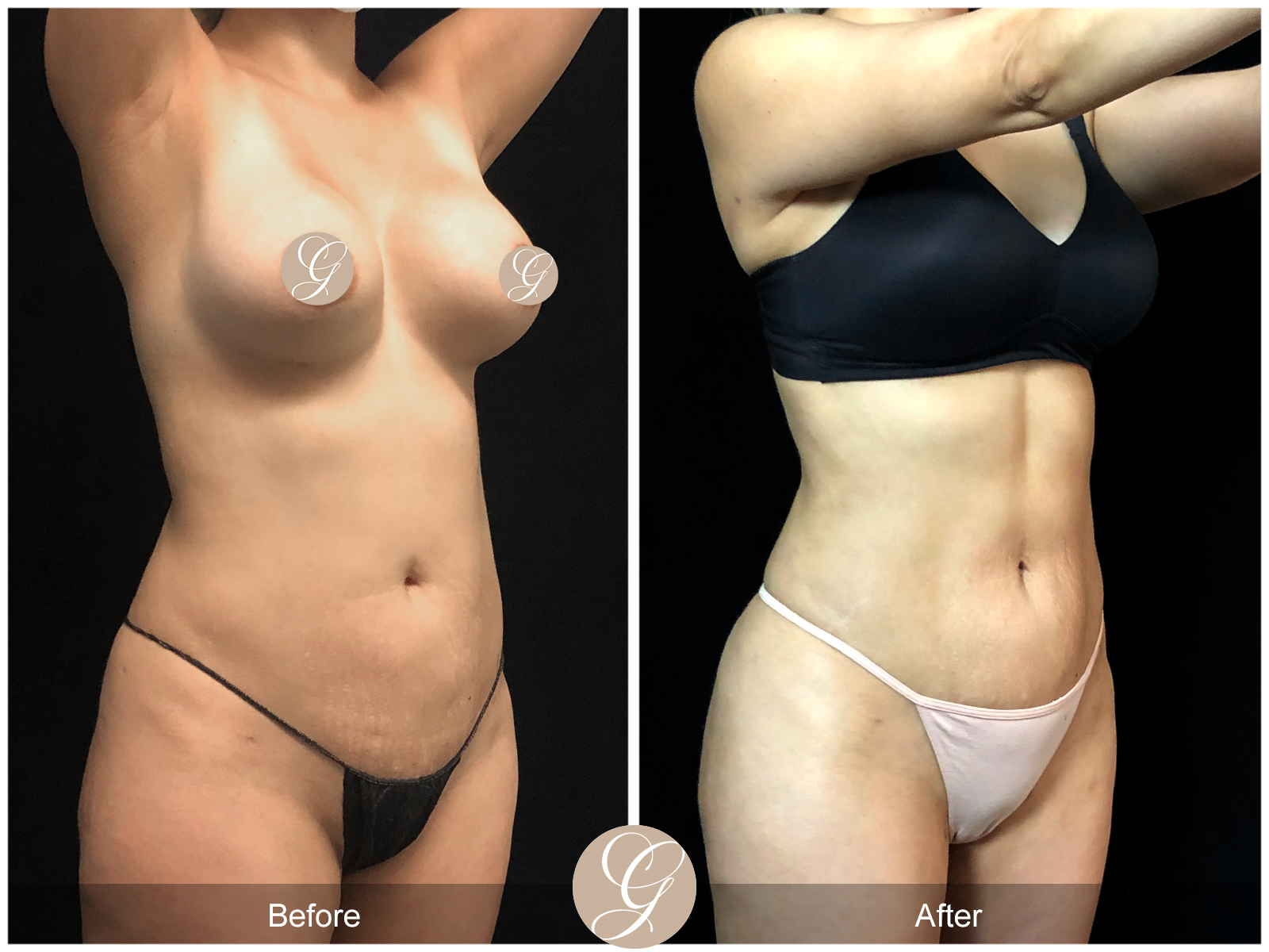 VASER 360 HIGH DEFINITION BODY SCULPTING PT12 Image
