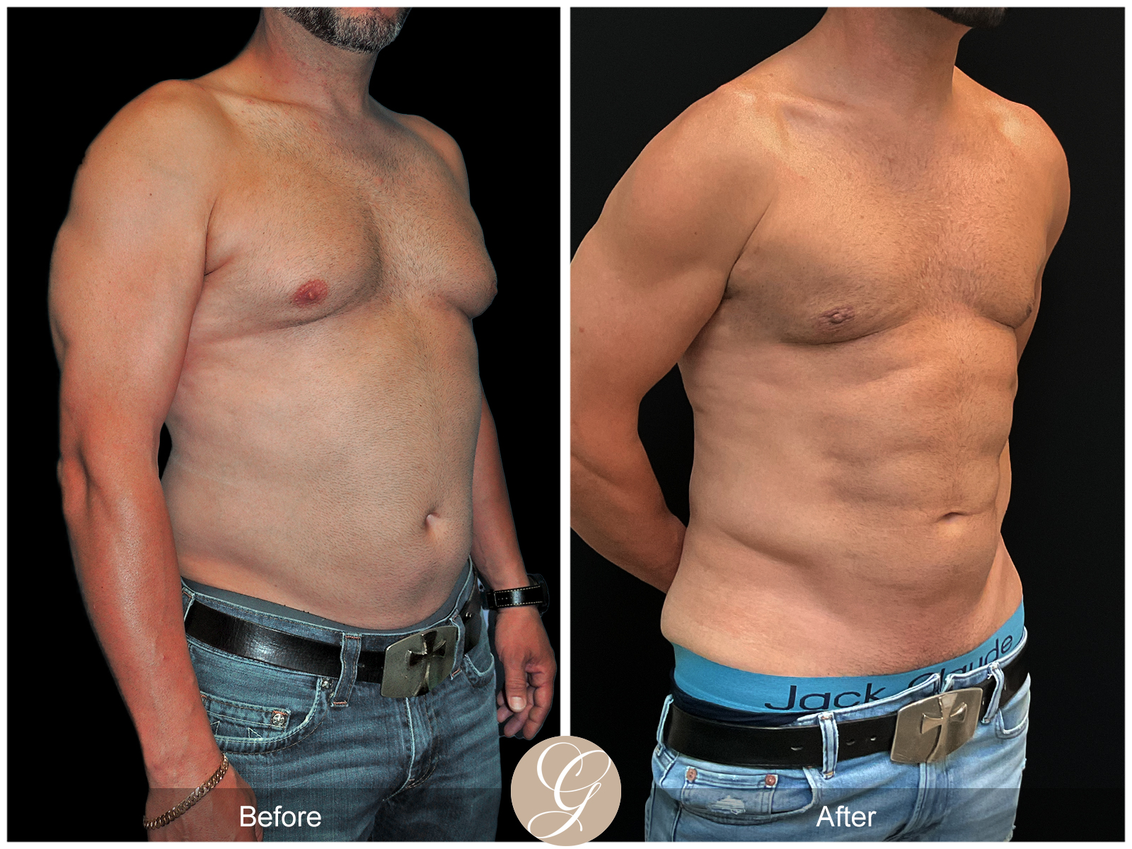Gynecomastia PT2 Image