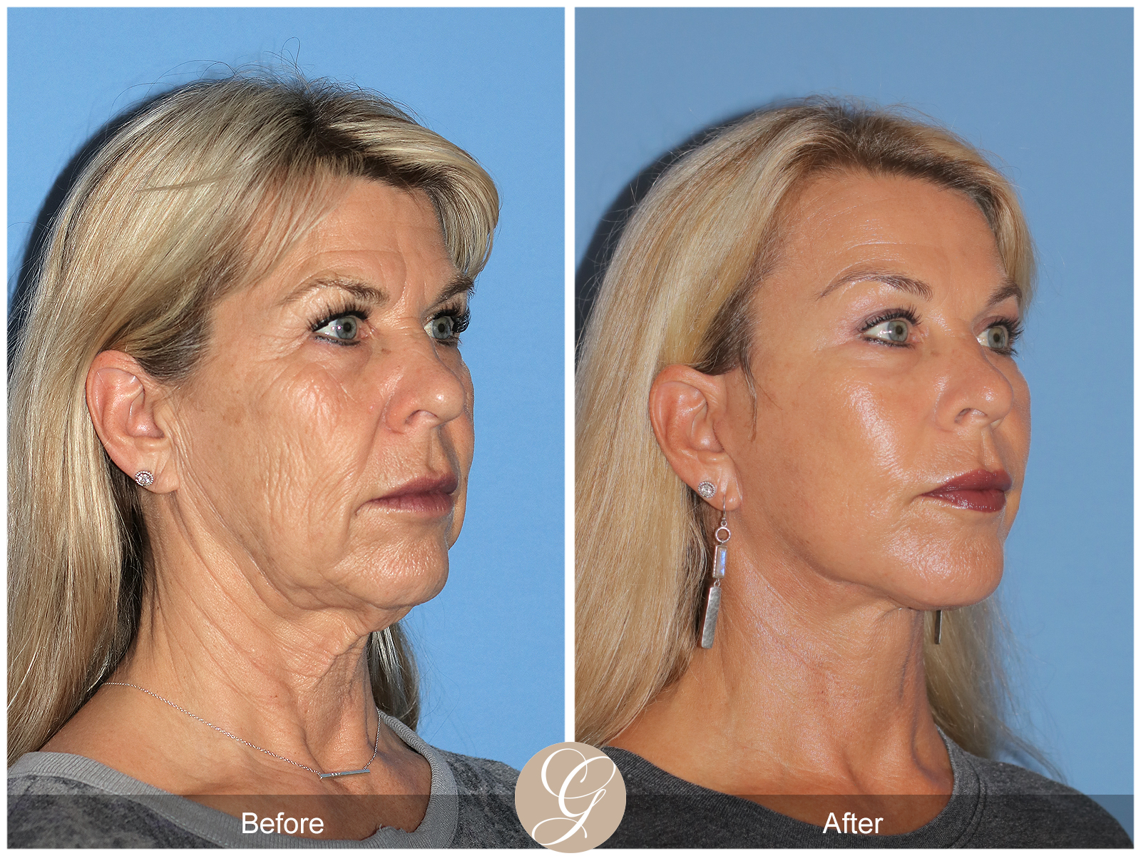 The Future of Facial Rejuvenation: The Preservation Deep Plane Faceligy by Dr. Kevin Sadati