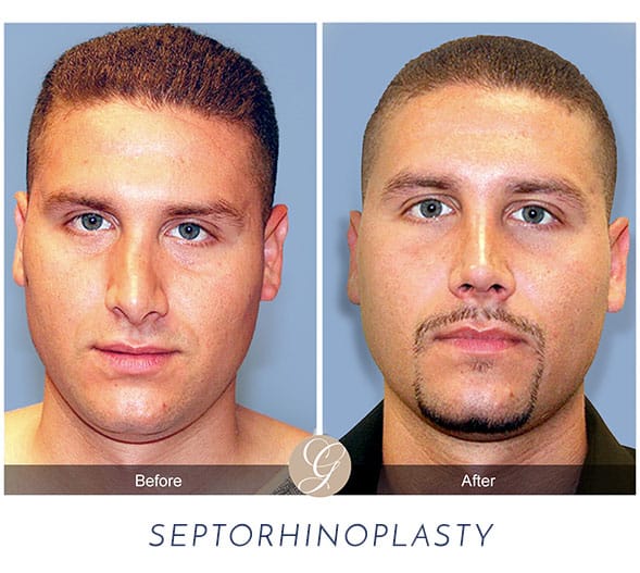Natural Rhinoplasty