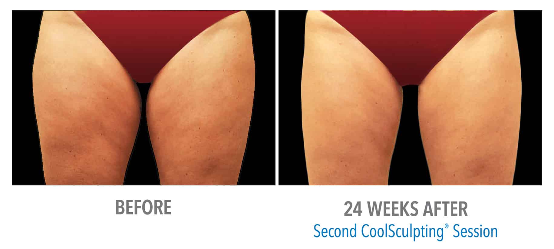Coolsculpting Case 1 Image