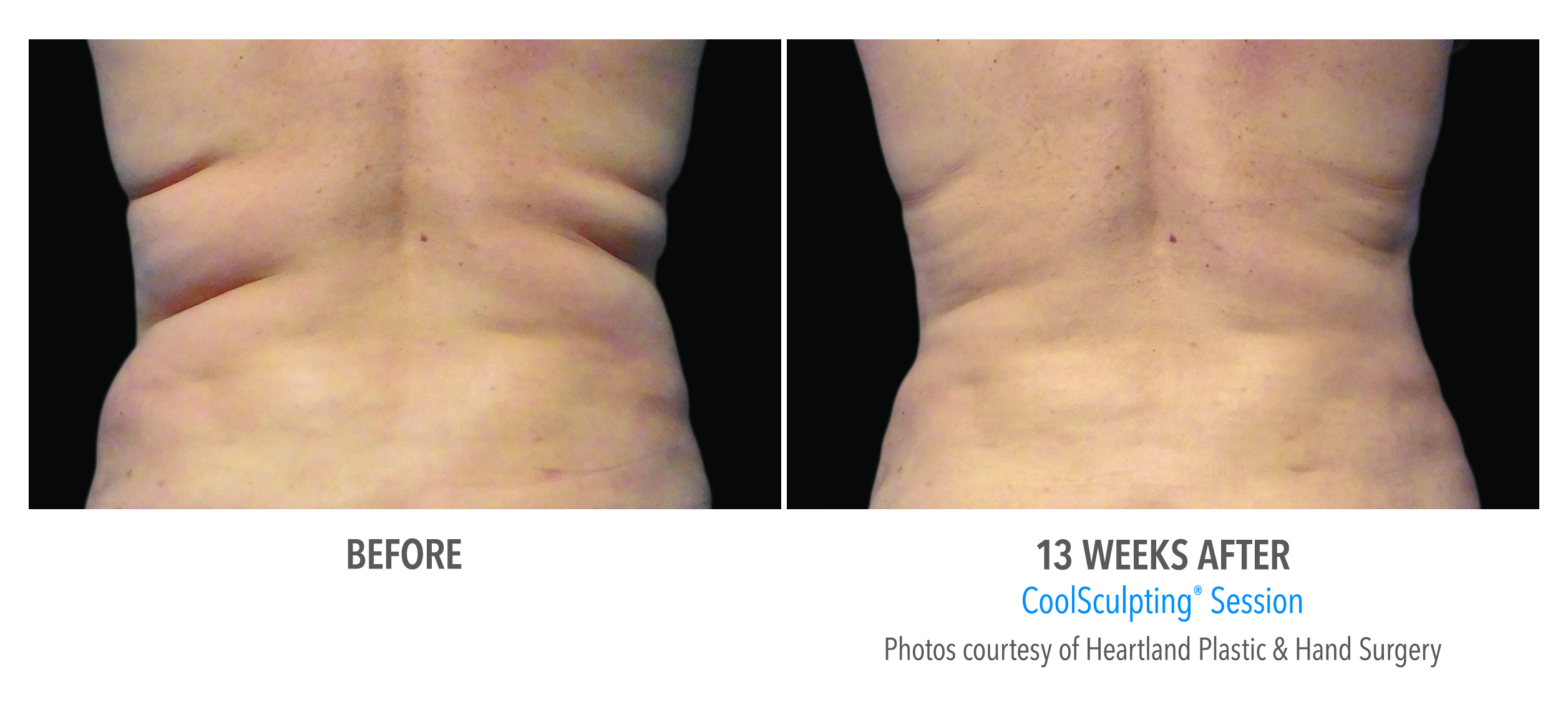 Coolsculpting Case 15 Image