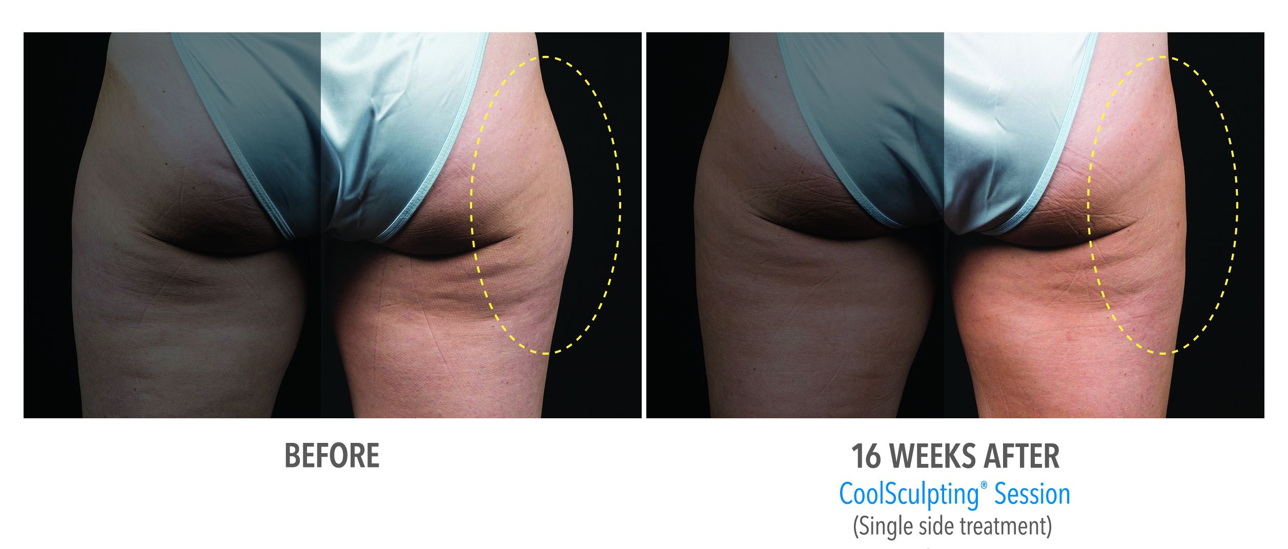 Coolsculpting Case 2 Image