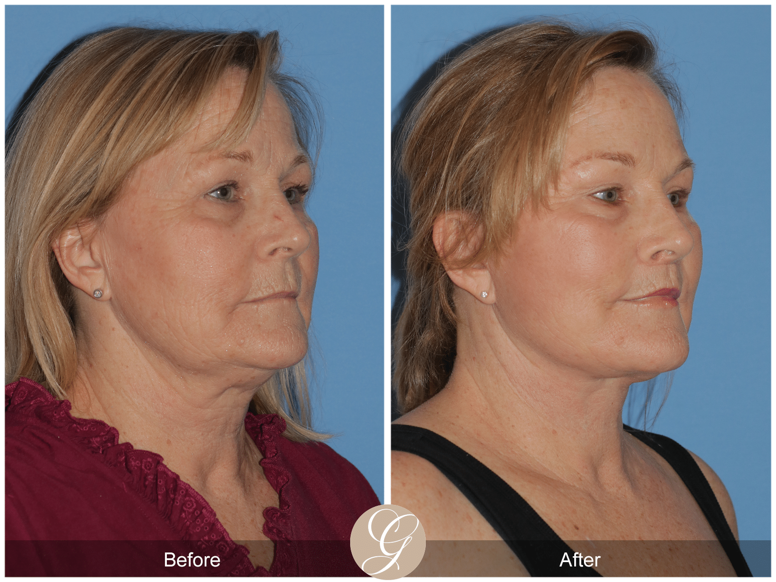 Vertical Facelift Case 5 Image