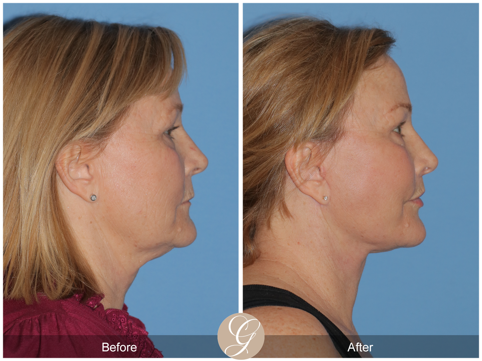 Vertical Facelift Case 5 Image