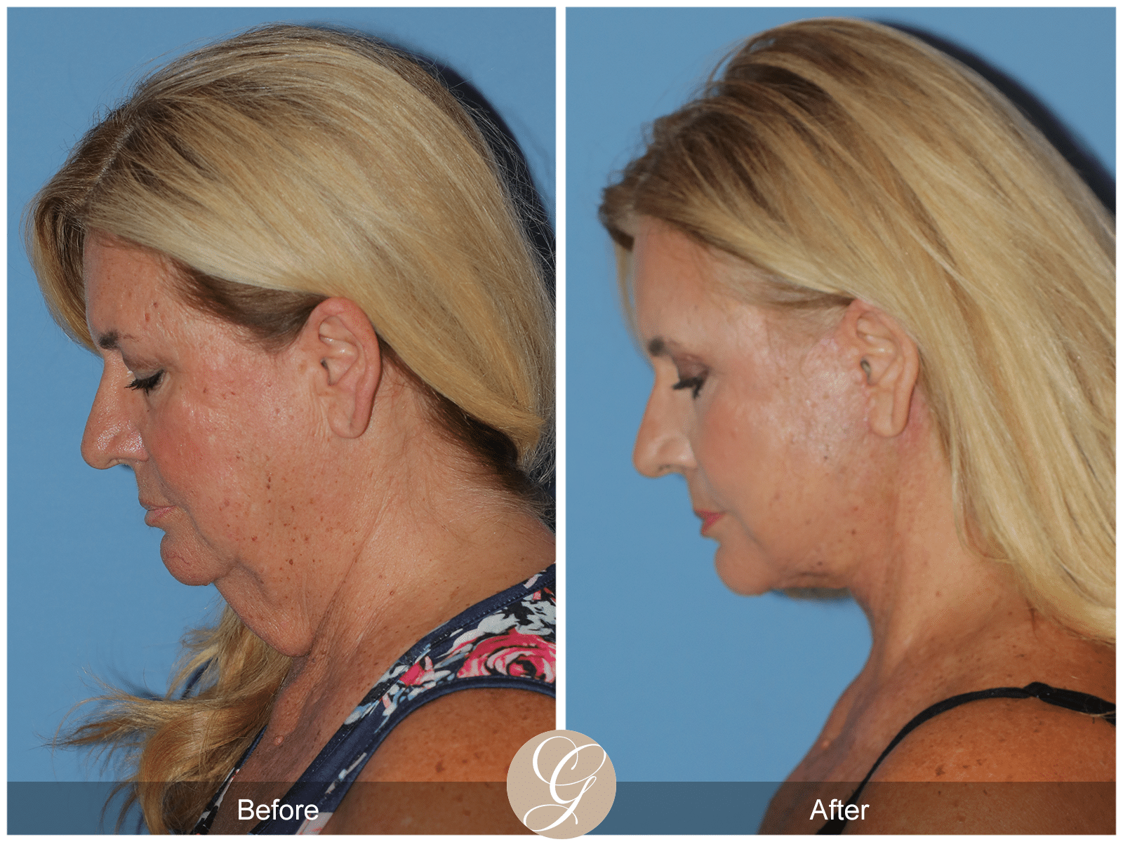 Deep Plane Facelift & Deep Plane Necklift Case 2 Image