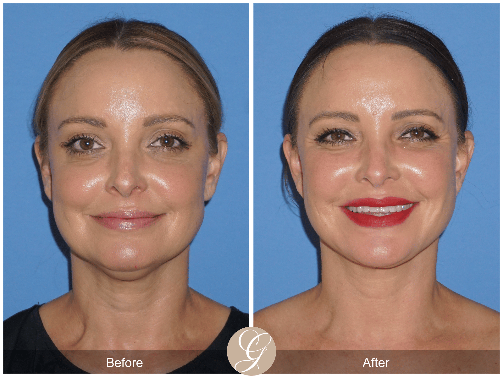 Lower Face and Neck Lift Case 2 Image
